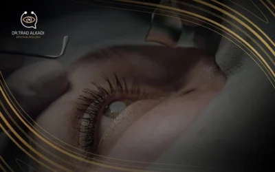 Eye Cataract Operation