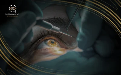 تعرف إلى العوامل المؤثرة في تكلفة زراعة حلقات القرنية في العين