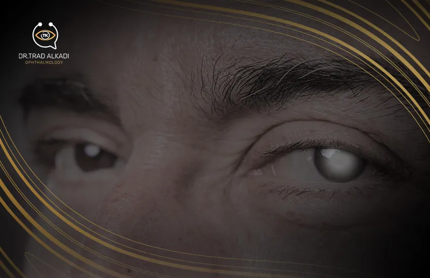 المياه البيضاء في العين