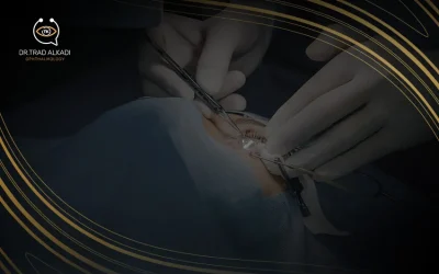 عملية زرع الحلقات للقرنية المخروطية